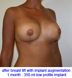 plastic-surgery-breast-lift-augmentation